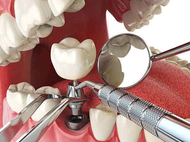Best Knocked-Out Tooth Emergency  in Rolling Hills Estates, CA